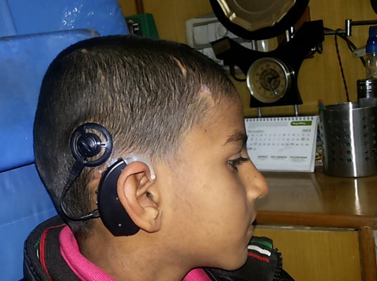 Cochlear Implant